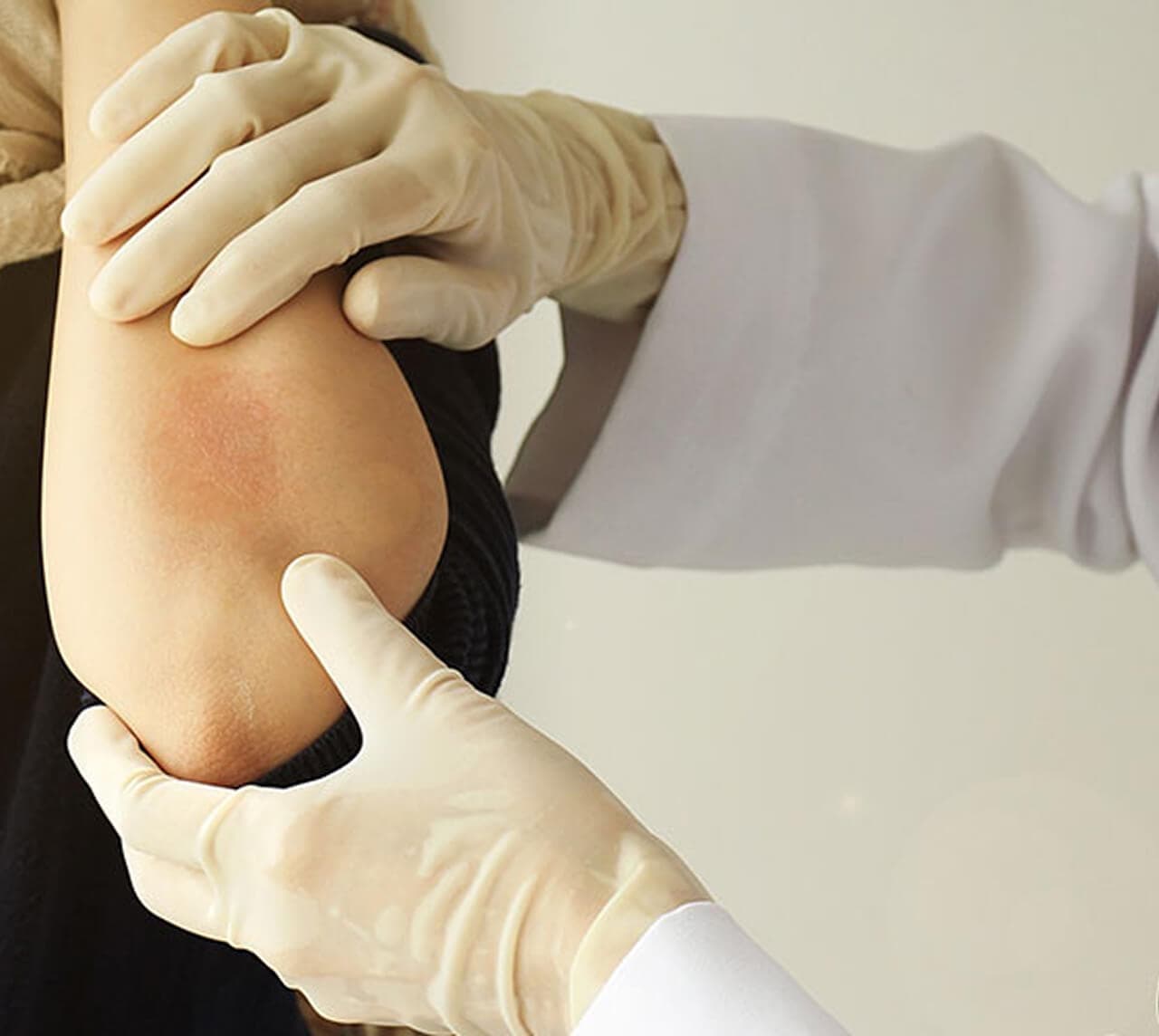 Control de psoriasis y dermatitis